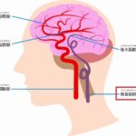 椎骨動脈解離のケア